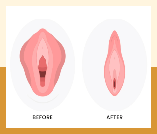 Labiaplasty