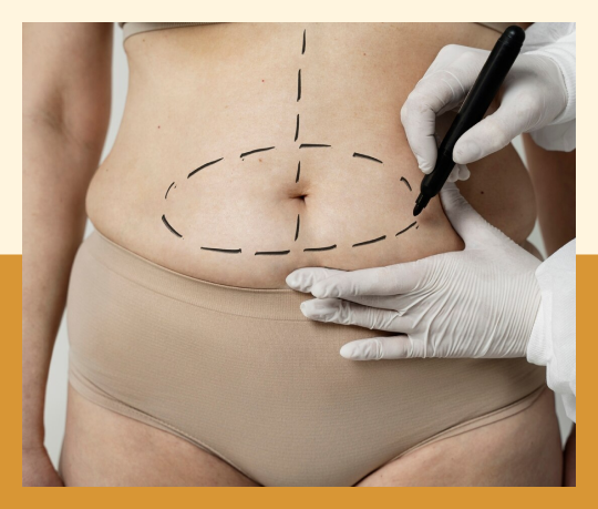 Hernia surgery with tummy tuck