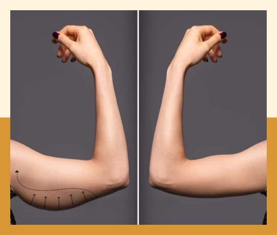 Arm lift (Brachy plasty)