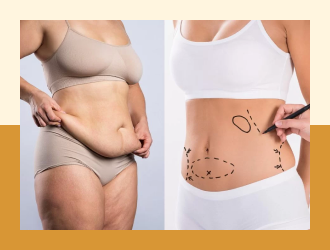 Lip Abdominoplasty / tummy tuck