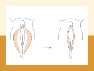 Vaginoplasty (surgical / non-surgical)