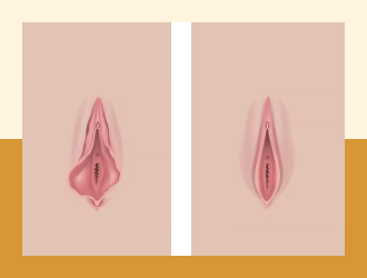 Labiaplasty
