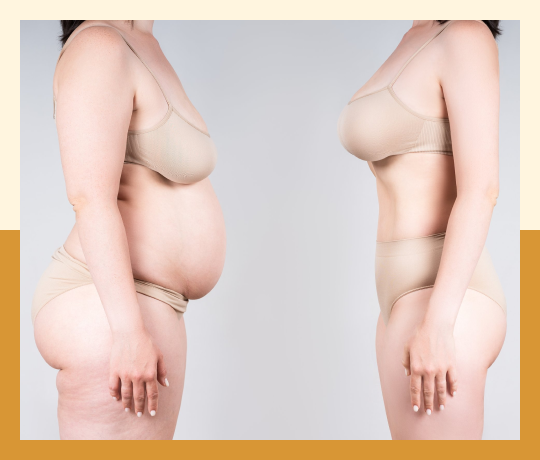 Breast augmentation
(Enhancement) - Fat grafting