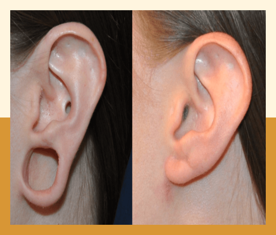 Ear lobe repair