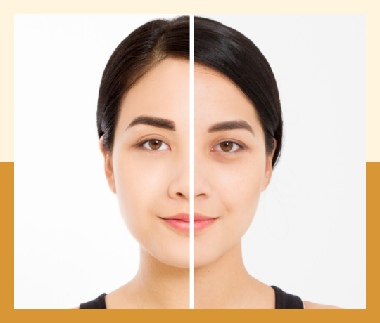 Facial fat grafting