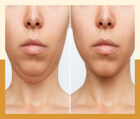 Double chin liposuction