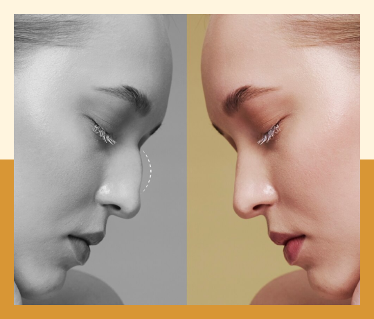 Rhinoplasty