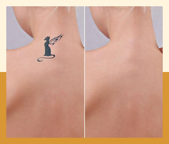 Tattoo Removal